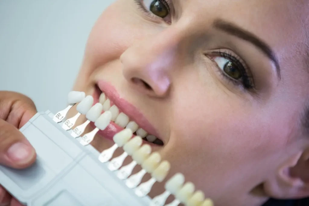 Composite Bonding vs. Porcelain Veneers