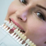 Composite Bonding vs. Porcelain Veneers: Which Is the Right Choice for You?