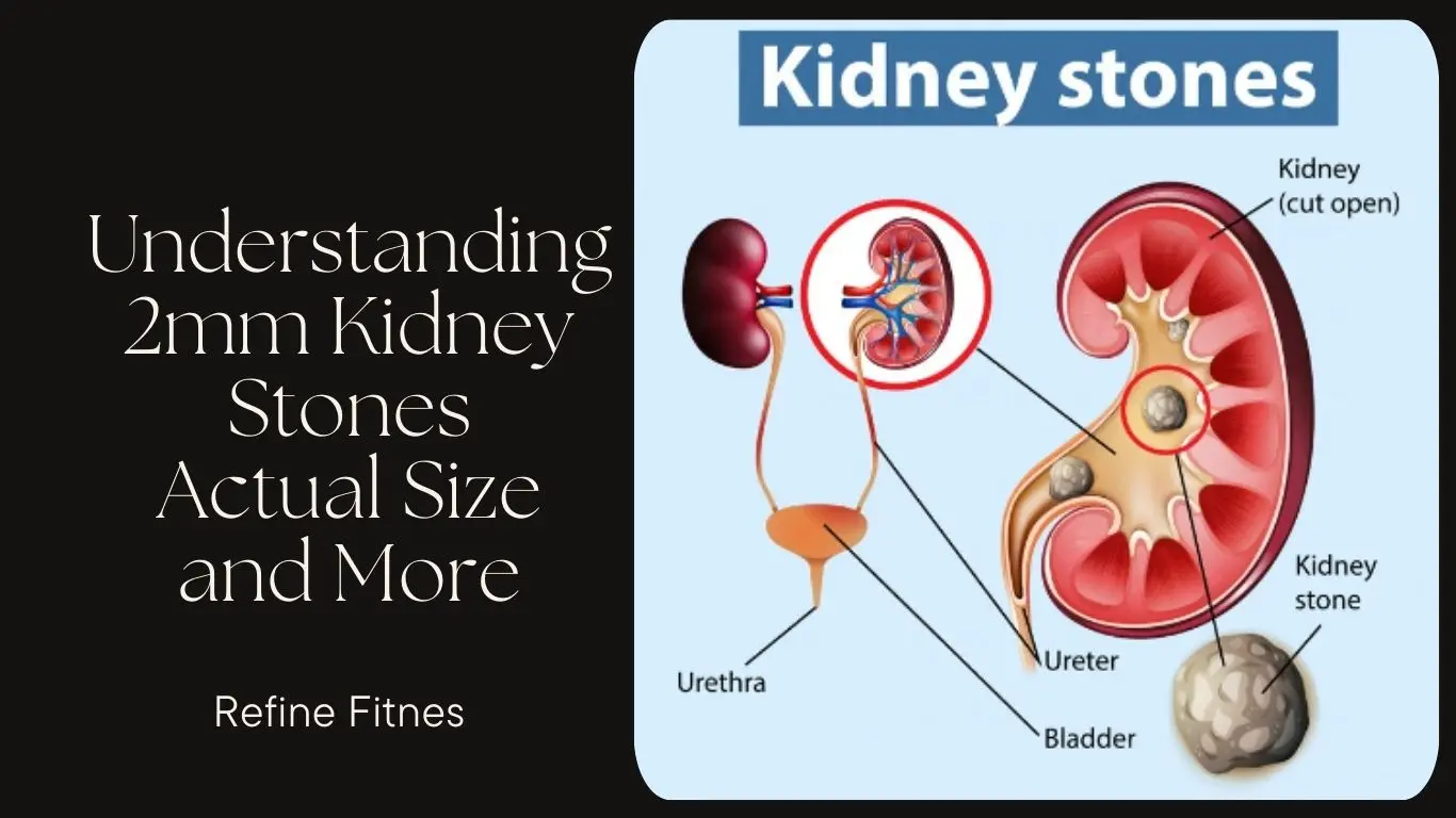 Understanding 2mm Kidney Stones: Actual Size and More