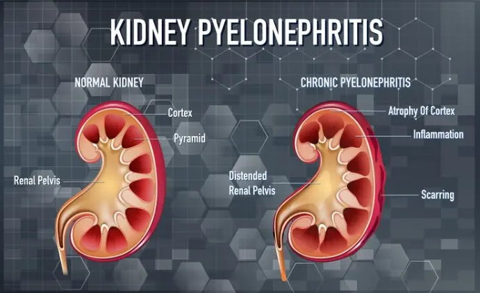 Symptoms of a 2mm Kidney Stone
