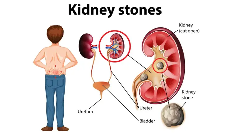 Treatment Options for Small Kidney Stones